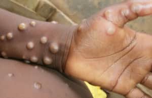 Monkeypox