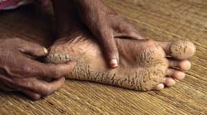 arsenic poisoning