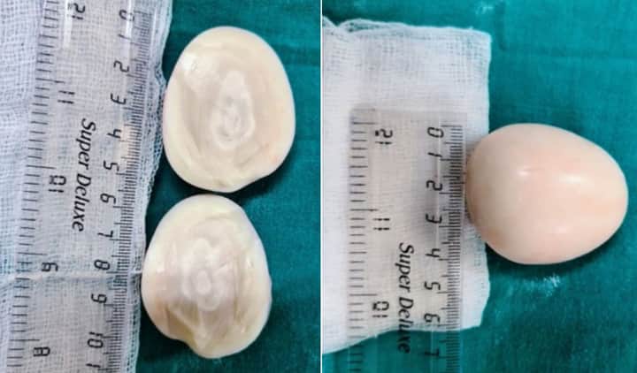 egg tumor Bengali News